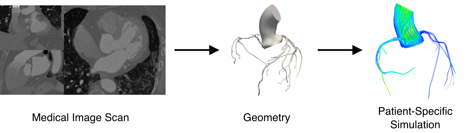 Patient-specific modeling pipeline: a medical image scan is converted into a 3D geometric model and then a blood flow simulation