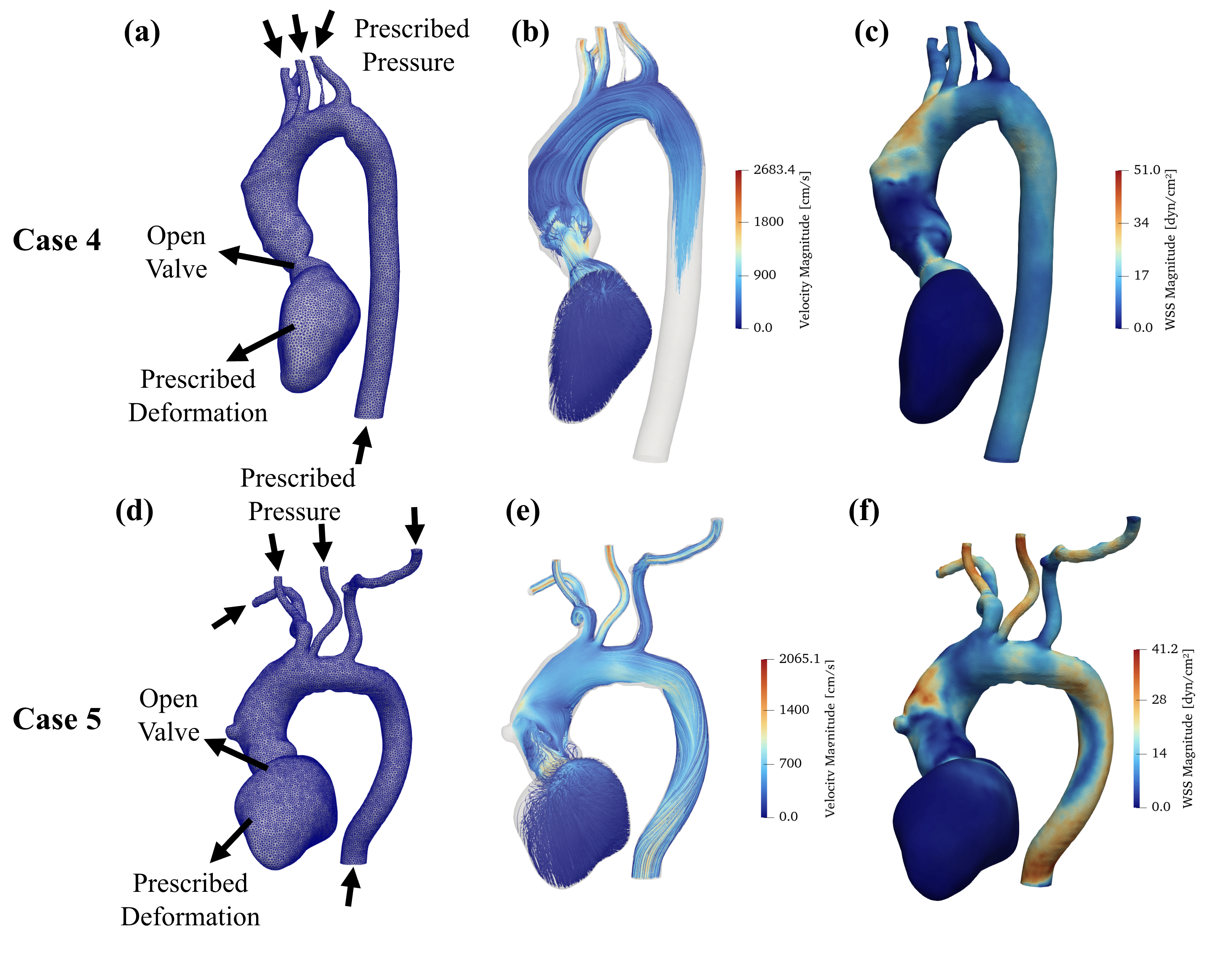 Computational fluid dynamics results for two cases: the boundary-condition setup with prescribed pressure, open valve, and prescribed deformation; velocity-magnitude streamlines; and wall shear stress magnitude.